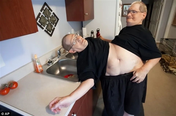 腹部相連只能輪流睡覺(jué)：世界長(zhǎng)壽男性連體雙胞胎 68歲同時(shí)去世
