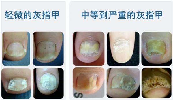 夏天從不敢露腳的人：都有這個(gè)難言之隱！