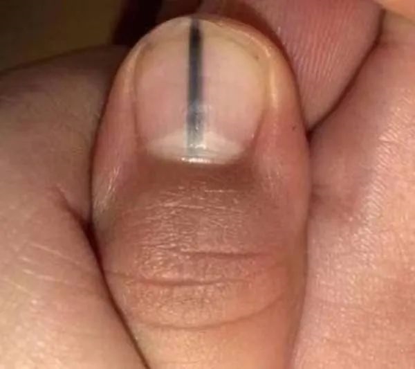 指甲出現(xiàn)一條黑線 別不當回事！可能是癌變