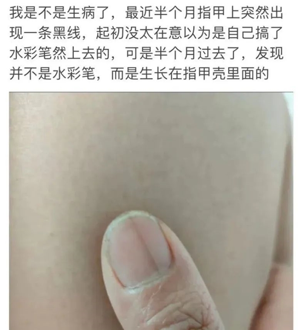 指甲出現(xiàn)一條黑線 別不當(dāng)回事！可能是癌變