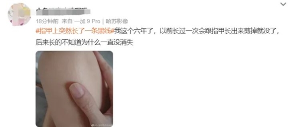 指甲出現(xiàn)一條黑線 別不當(dāng)回事！可能是癌變
