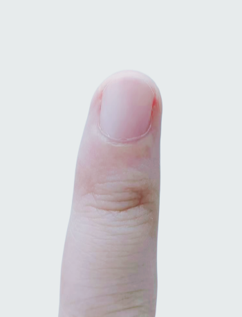 指甲出現(xiàn)一條黑線 別不當(dāng)回事！可能是癌變