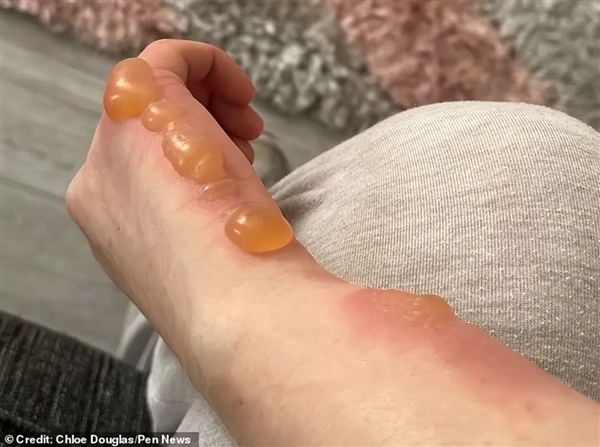 英國引入觀賞 沒成想是超級毒草：碰一下起大泡 一滴就眼瞎