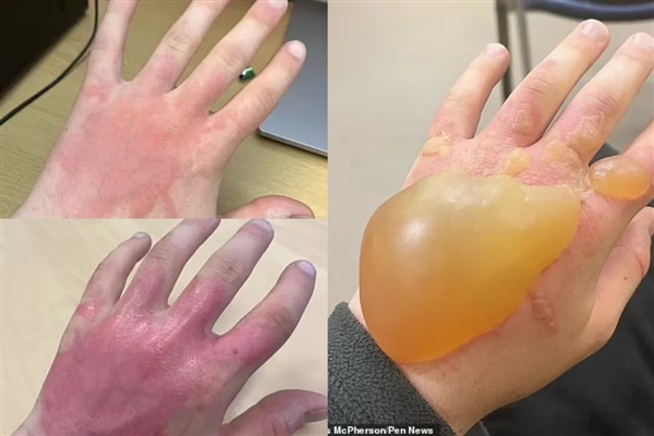 英國引入觀賞 沒成想是超級毒草：碰一下起大泡 一滴就眼瞎