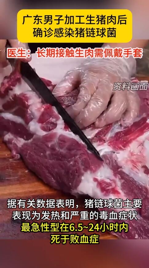 男子帶傷切豬肉感染豬鏈球菌長(zhǎng)滿瘀斑：送醫(yī)后直接進(jìn)了ICU