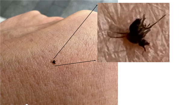 身上突然不明原因癢一下、又紅又腫：不是蚊子咬的