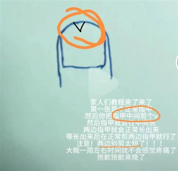 剪指甲的一個(gè)小習(xí)慣：可能導(dǎo)致甲溝炎反復(fù)發(fā)作！