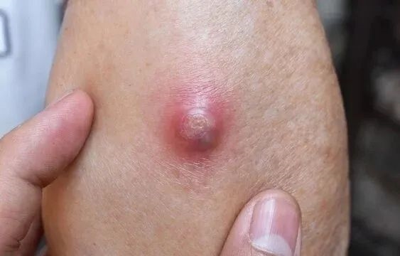 一種“紅包”又痛又腫：硬擠還很危險