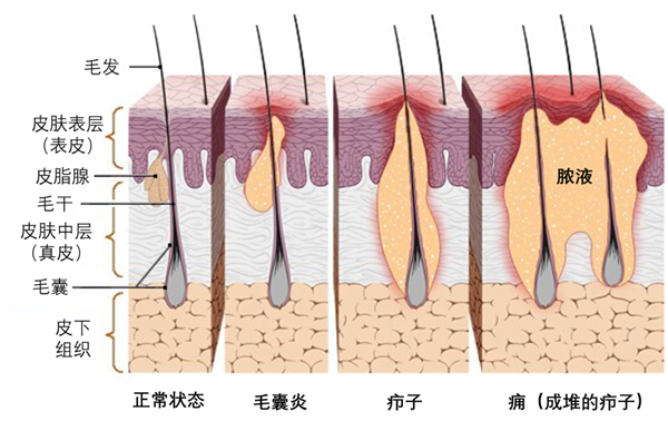 一種“紅包”又痛又腫：硬擠還很危險