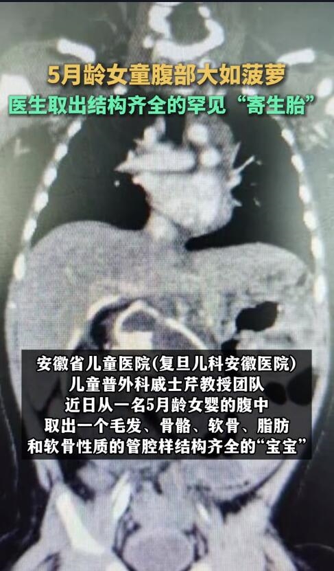 5月齡女嬰肚子變大腹中取出寄生胎：業(yè)內罕見