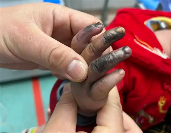 1歲寶寶誤觸充電口手指瞬間焦黑：曾有多人中招