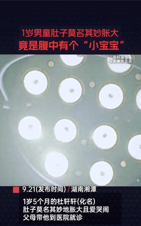 1歲男童腹中竟有個(gè)小寶寶：醫(yī)學(xué)罕見