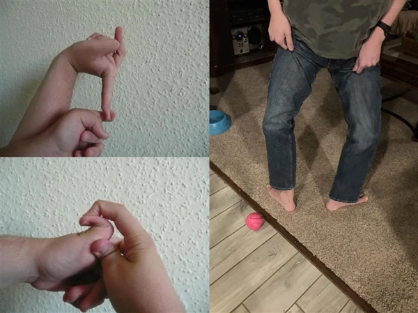 英國男子皮膚Q彈破紀(jì)錄：脖子皮膚一拉可當(dāng)口罩戴