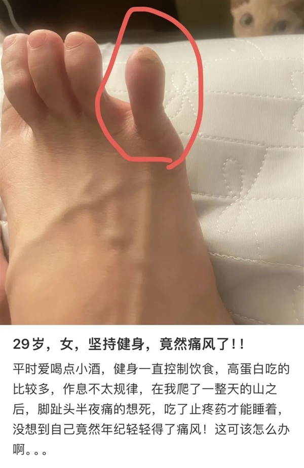 痛風(fēng) 正在席卷中國年輕人......