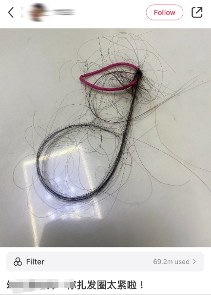 女生頭骨骨折進ICU 這種“奪命網紅飾品”真的別再用了！