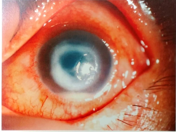 那些常年戴隱形眼鏡的人 后來都咋樣了  4個傷害很難避免