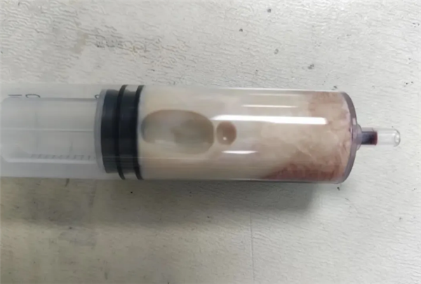 男子吃7天漢堡后抽出牛奶血：高脂性胰腺炎可致命