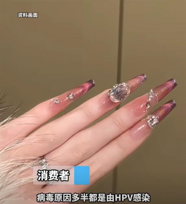 女子美甲后感染HPV病毒長出菜花：醫(yī)生建議盡量少做美甲