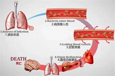 大S死因改為敗血癥：和肺炎關(guān)系密切 死亡率可達(dá)60％！