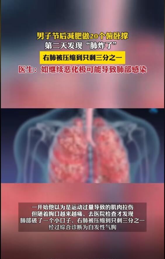 男子減肥做20個(gè)俯臥撐后“肺炸了”：右肺被壓縮到只剩三分之一