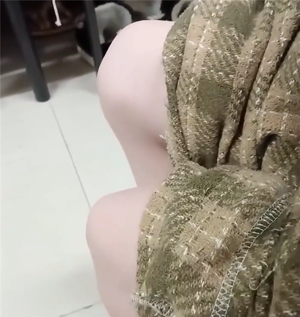 真正的骨骼驚奇：19歲女孩天生髕骨脫位雙膝可隨意移動